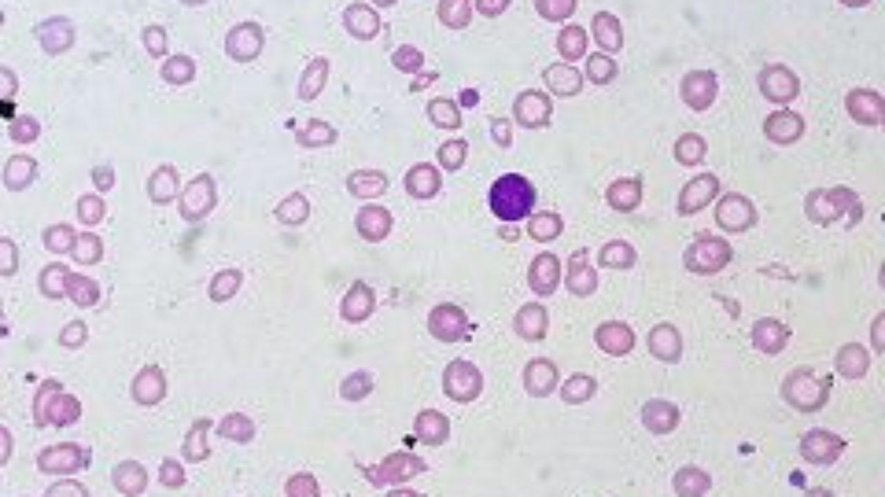 Resultado de imagen de anemia lifeder