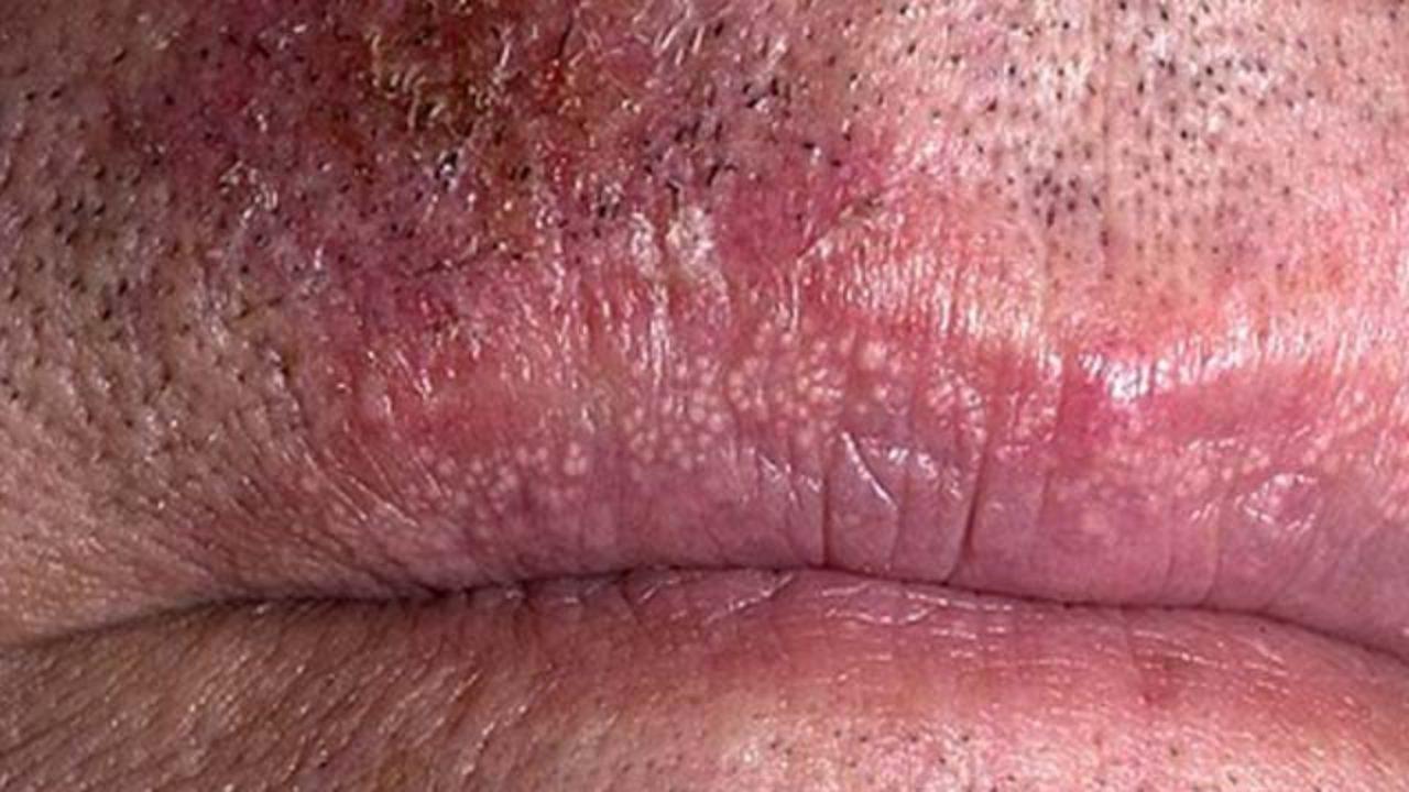 Porque salen granos blancos en los testiculos