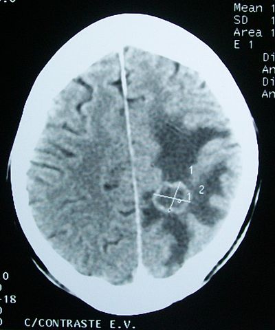 ¿Una tomografía computarizada detecta daño cerebral