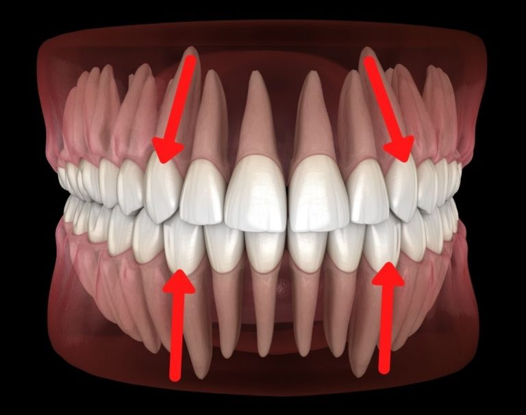 Dientes caninos concepto, anatomía, partes, funciones, patologías Dientes caninos concepto, anatomía, partes, funciones, patologías