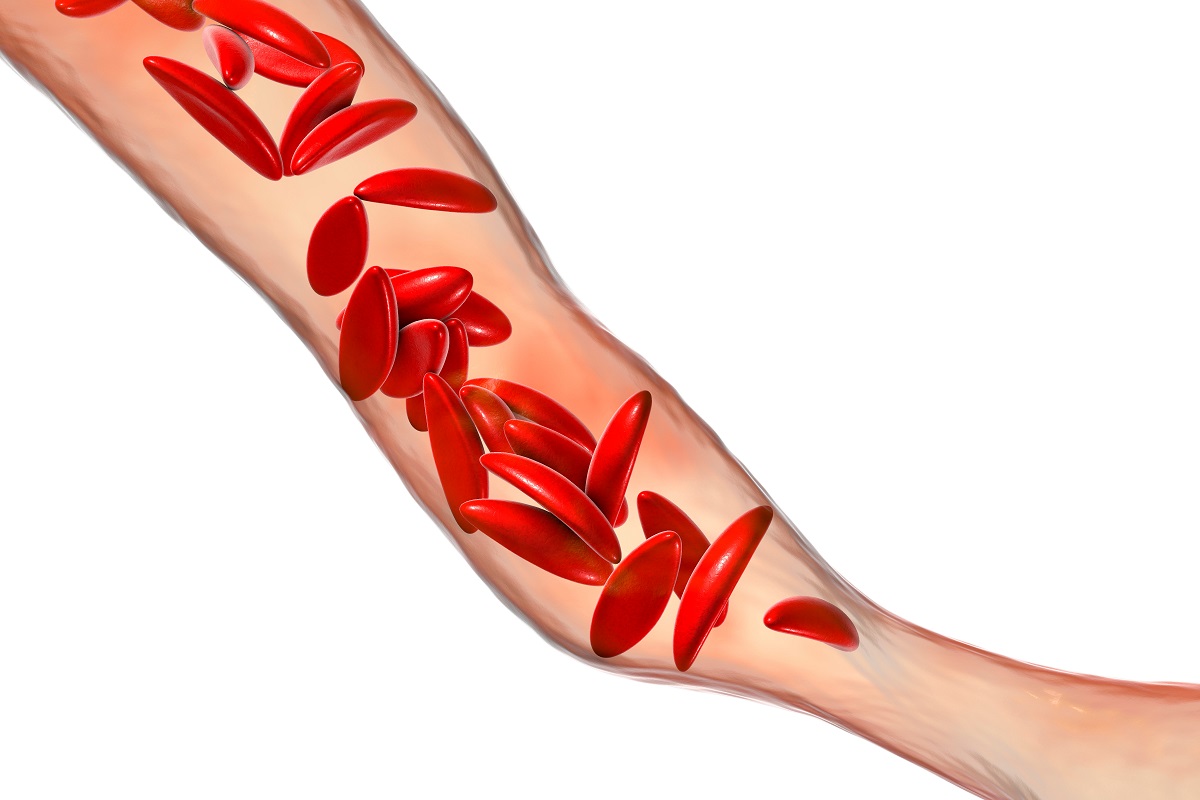 Sickle Cell Anemia Treatment: Breakthrough Cure Insights