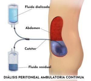 Líquido peritoneal