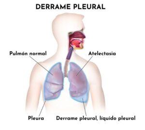 Líquido pleural