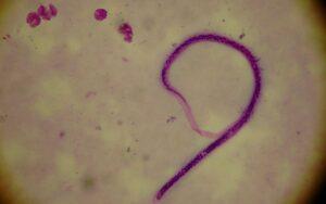 Wuchereria bancrofti