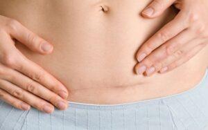 Cuidados después de una cesárea