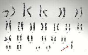 Síndromes cromosómicos