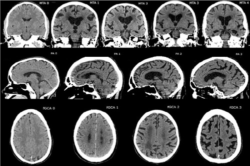 Atrofia Cerebral Caracteristicas Sintomas Y Causas