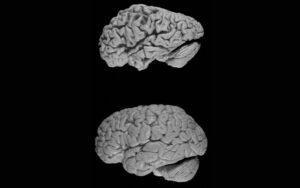 Atrofia cerebral