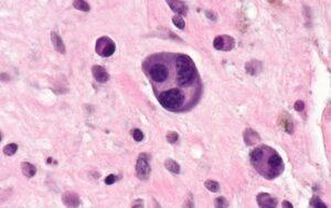 Células plasmáticas