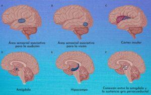 Epilepsia del lóbulo temporal