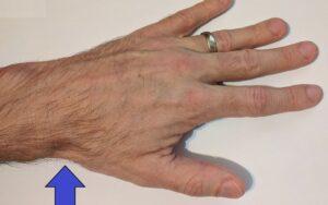 Tabaquera anatómica